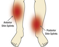 Shin_splints